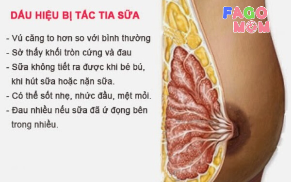 Dấu hiệu bị tắc tia sữa ở phụ nữ là gì?