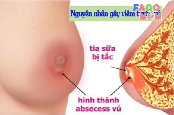 Nguyên nhân dẫn đến tình trạng viêm tuyến vú
