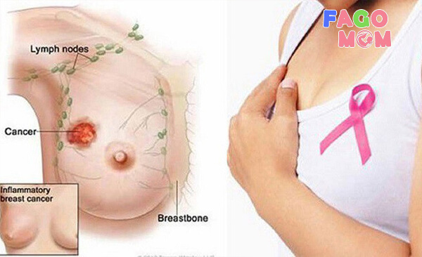 Phương pháp điều trị viêm tuyến vú