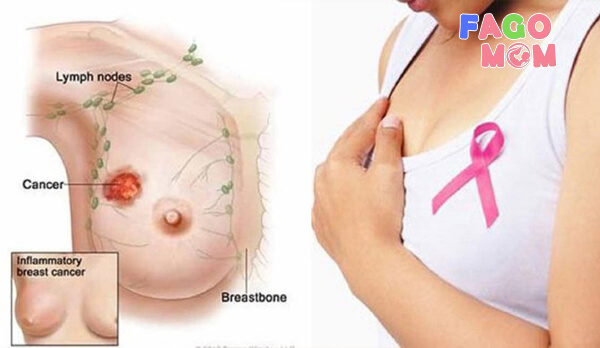 Triệu chứng dẫn đến căng tức ngực sữa sau sinh