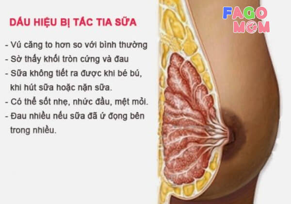 Biểu hiện về tình trạng bị tắc tia sữa