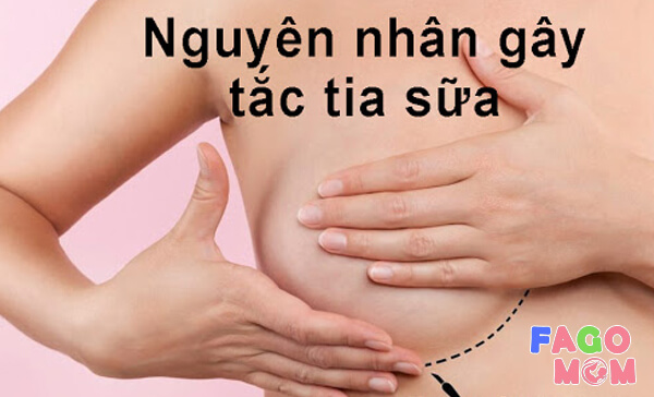 Nguyên nhân dẫn đến tắc tia sữa ở phụ nữ sau sinh