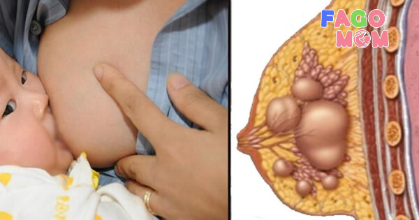 Bị tắc tia sữa nghĩa là như thế nào