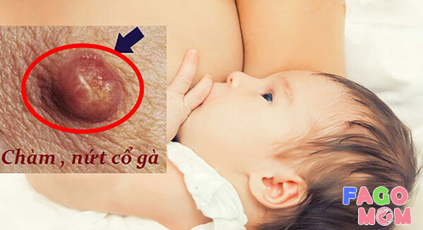 Tìm hiểu về tình trạng bị nứt đầu ti